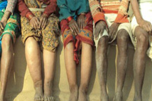 रंगेली नगरपालिकामा ३५ जना हात्तीपाइले रोगी भेटिए