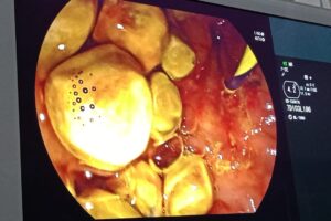 नोवेल अस्पतालमा ‘इआरसीपी’ प्रविधीबाट खोटाङको पदमकुमारी राईको सफल उपचार